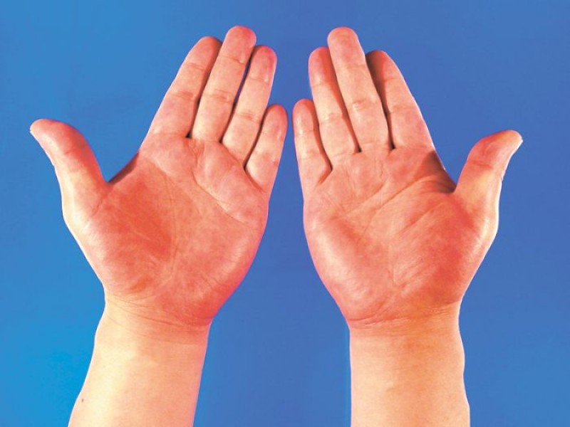 articulațiile umflate ale palmelor tratament articular arshan