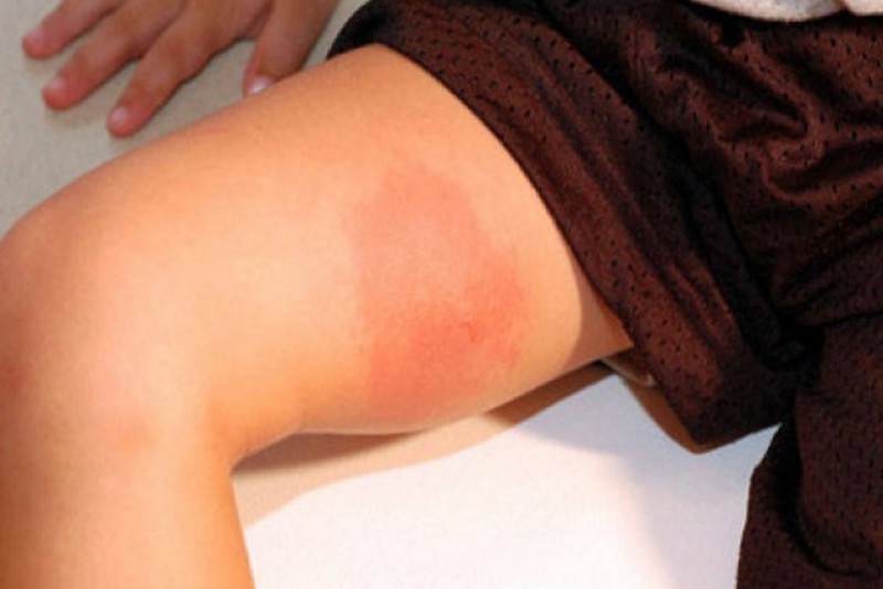 tratamentul înțepăturii de albine a genunchiului tratamentul leziunilor infecțioase articulare