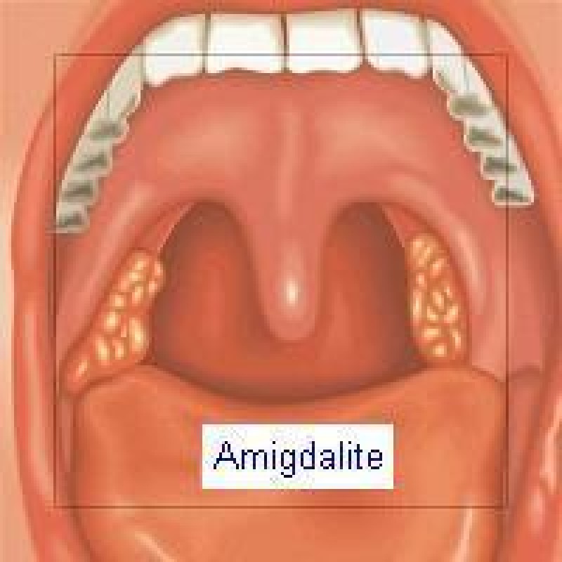 SANATATE - Când este indicată scoaterea amigdalelor?