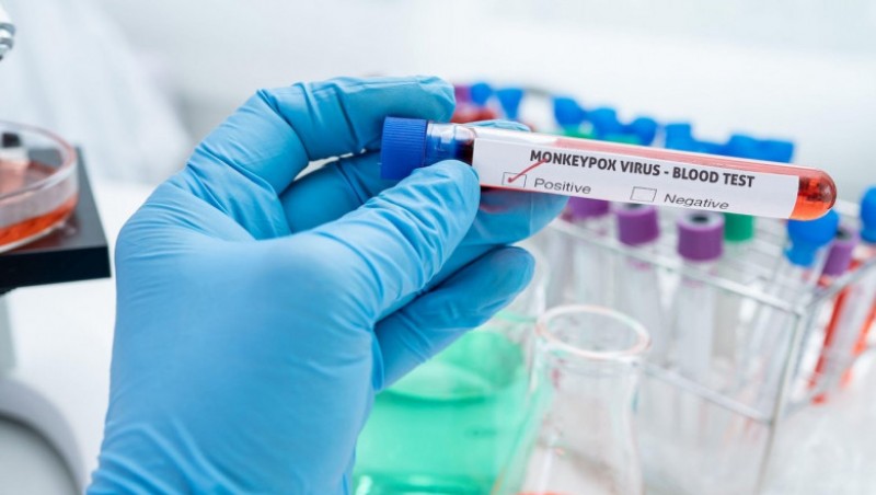 Trei noi cazuri de variola maimuței au fost diagnosticate în România